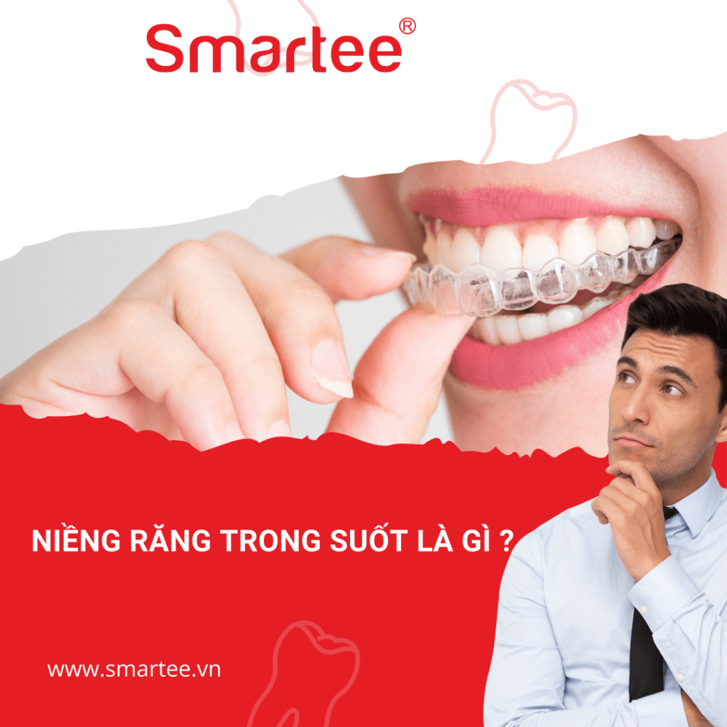 niềng răng trong suốt là gì 